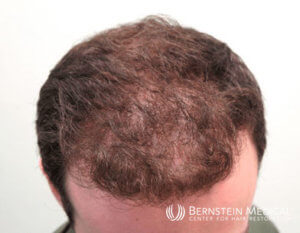 etiket absurd Derivation Case 8: Oral Minoxidil - Bernstein Medical - Center for Hair Restoration