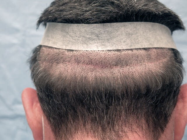 Donor Area in Hair Transplant Surgery | Bernstein Medical