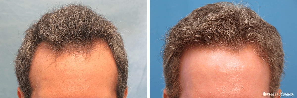 Bernstein Medical - Patient FCB Before and After Hair Transplant Photo 