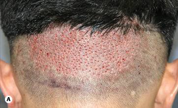 Figure 29.18A - FUE Immediately after harvesting 600 grafts