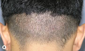 Figure 29.18B - FUE Six days post-op