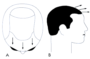 Figure 29.19 - Normal hair direction