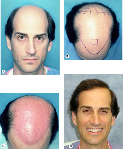 Figure 29.24 - Before and 1 year after two sessions totaling 4295 follicular unit grafts