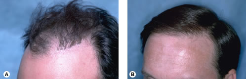 Figure 29.30 - Before hair transplant and camouflage from one session