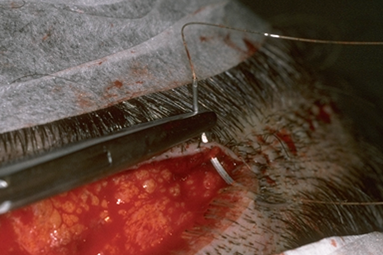 Figure 29.9 - Suturing the donor area using absorbable sutures