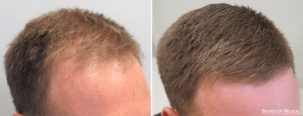 how long does minoxidil shedding last