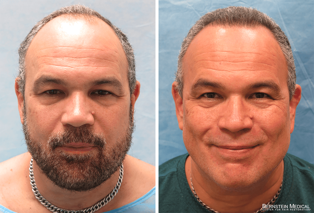 Bernstein Medical - Patient FVO Before and After Hair Transplant Photo