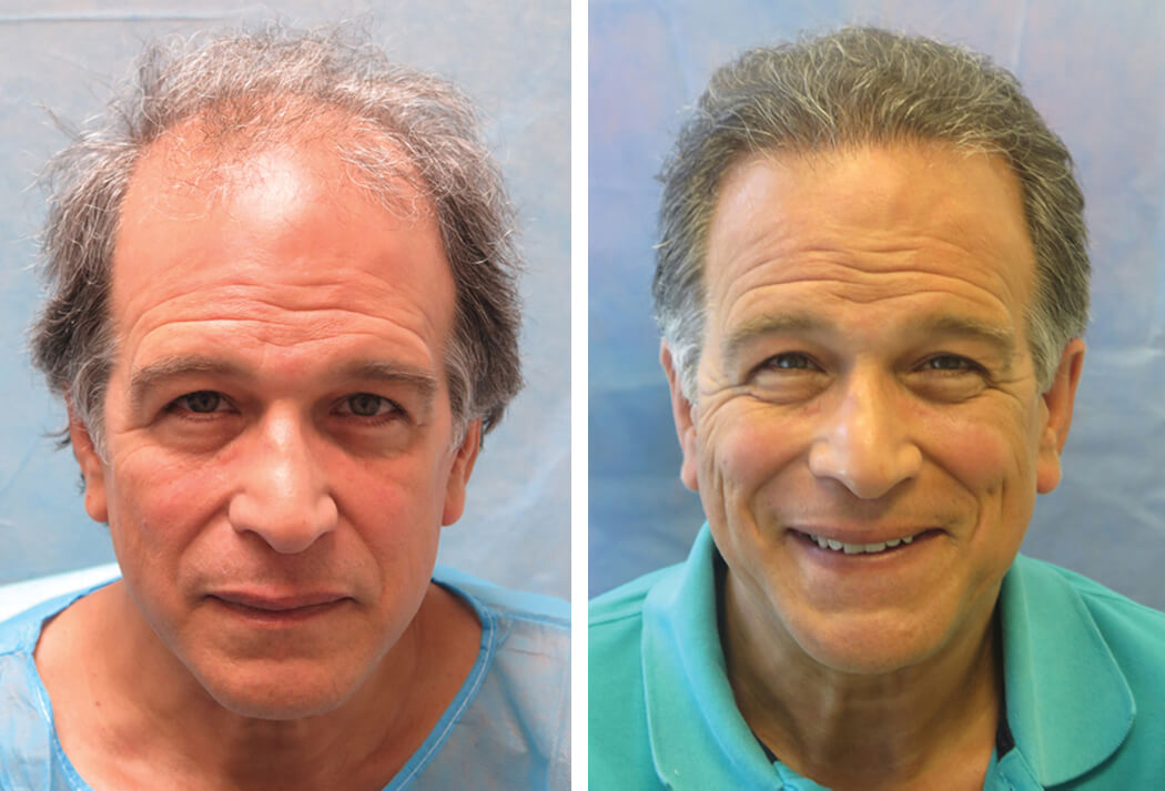Bernstein Medical - Patient ALA Before and After Hair Transplant Photo 