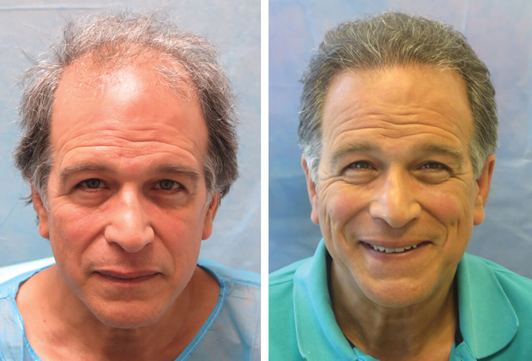 Bernstein Medical - Patient ALA Before and After Hair Transplant Photo