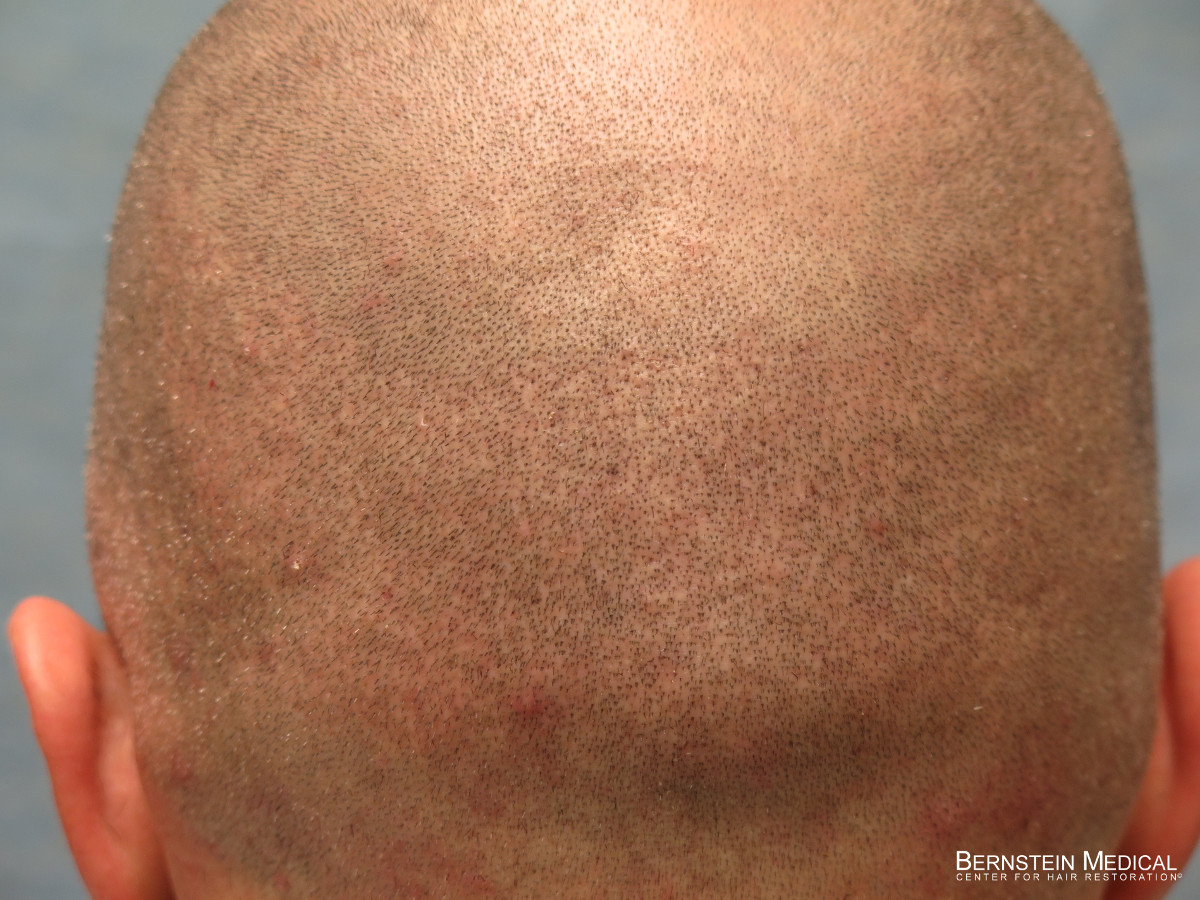 3mo Post-op: Shaved with Peanut Clippers (Close Up)