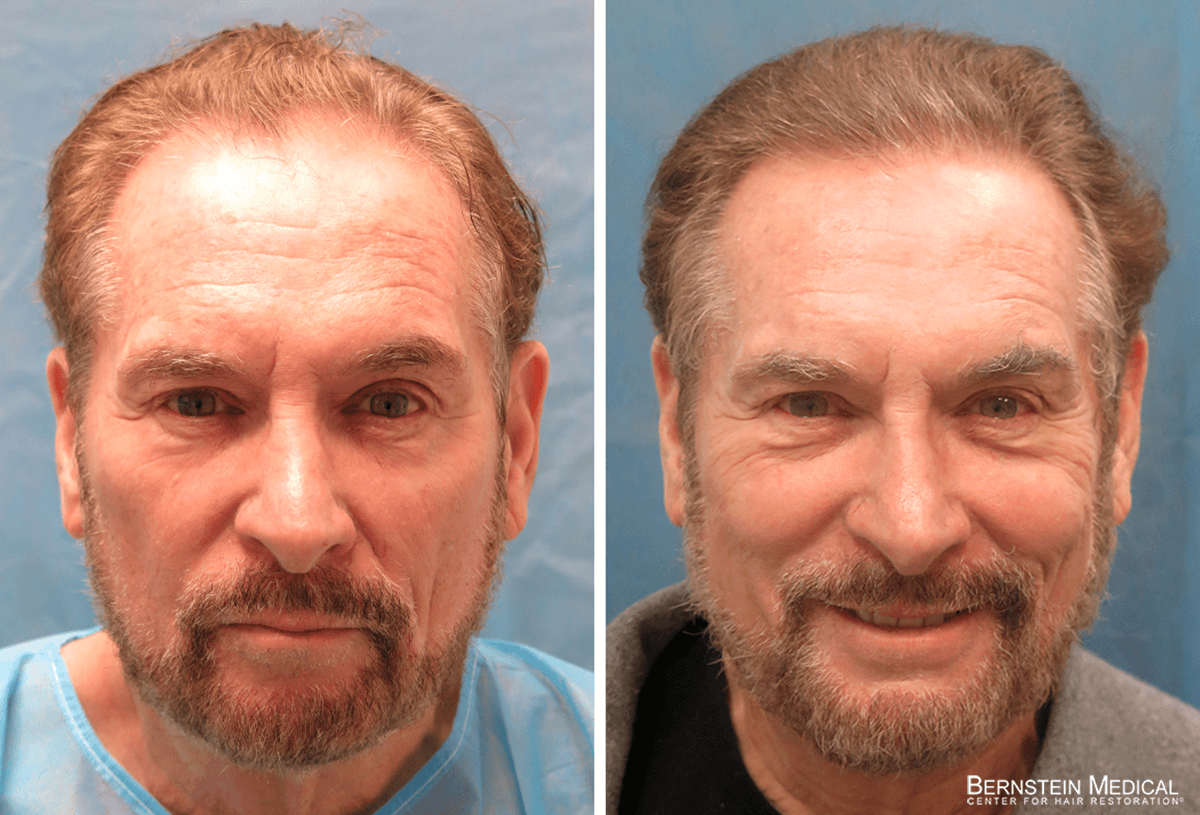 Bernstein Medical - Patient QBQ Before and After Hair Transplant Photo 
