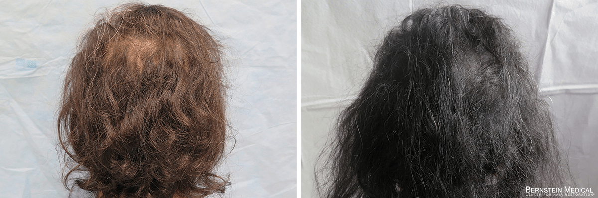 Bernstein Medical - Patient QYZ Before and After Hair Transplant Photo