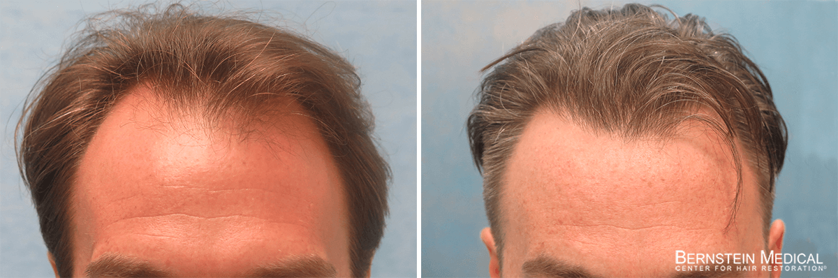 Bernstein Medical - Patient RMB Before and After Hair Transplant Photo