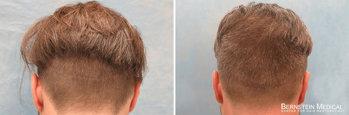 Bernstein Medical - Patient RMB Before and After Hair Transplant Photo