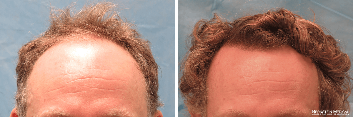 Bernstein Medical - Patient RUZ Before and After Hair Transplant Photo 