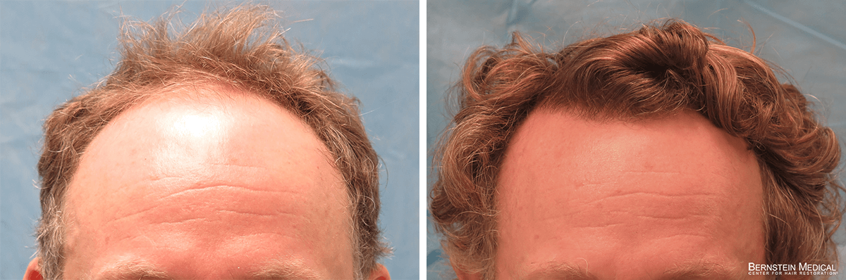 Bernstein Medical - Patient RUZ Before and After Hair Transplant Photo