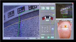 ARTAS Robotic System display monitor showing parameters for the creation of recipient sites