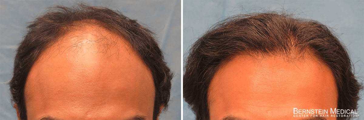Bernstein Medical - Patient SBL Before and After Hair Transplant Photo 