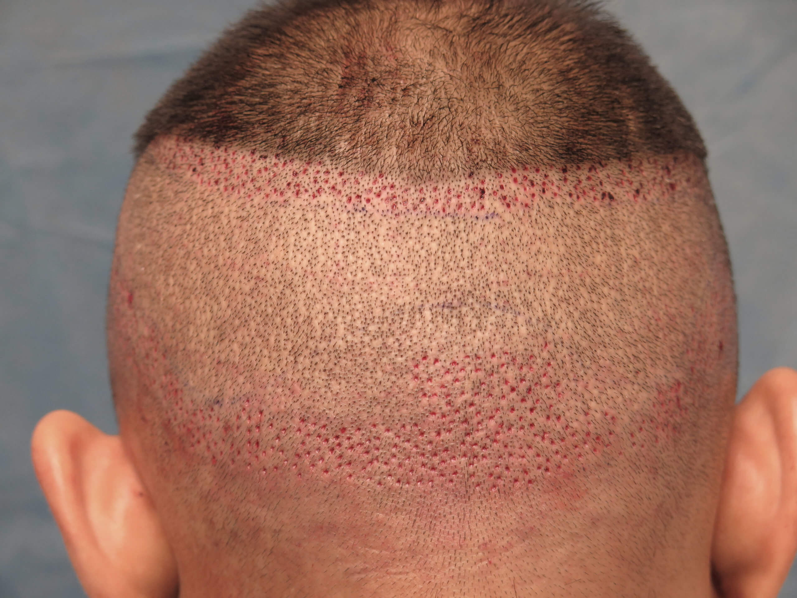 ARTAS Robotic Hair Transplants | Bernstein Medical ARTAS Robotic Hair Transplants | Bernstein Medical