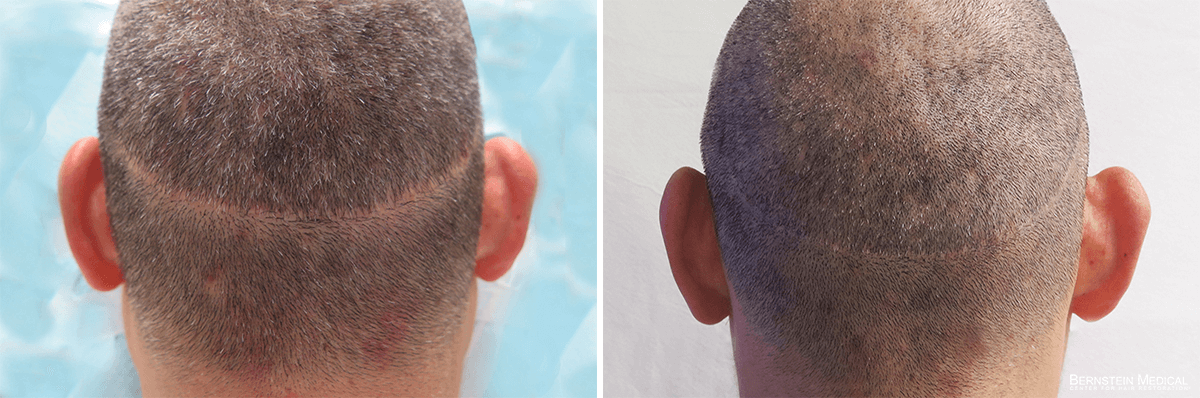 Bernstein Medical - Patient VNB Before and After Hair Transplant Photo 
