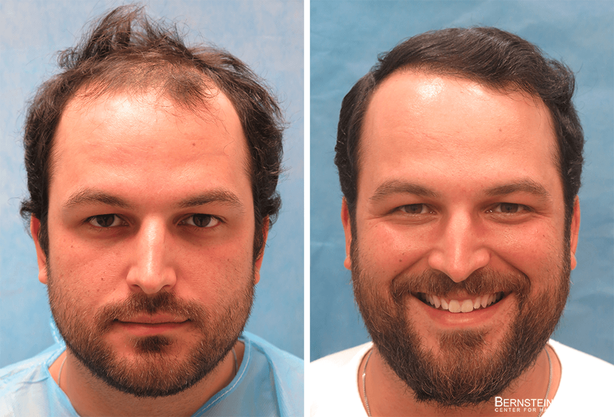 Bernstein Medical - Patient XMZ Before and After Hair Transplant Photo 