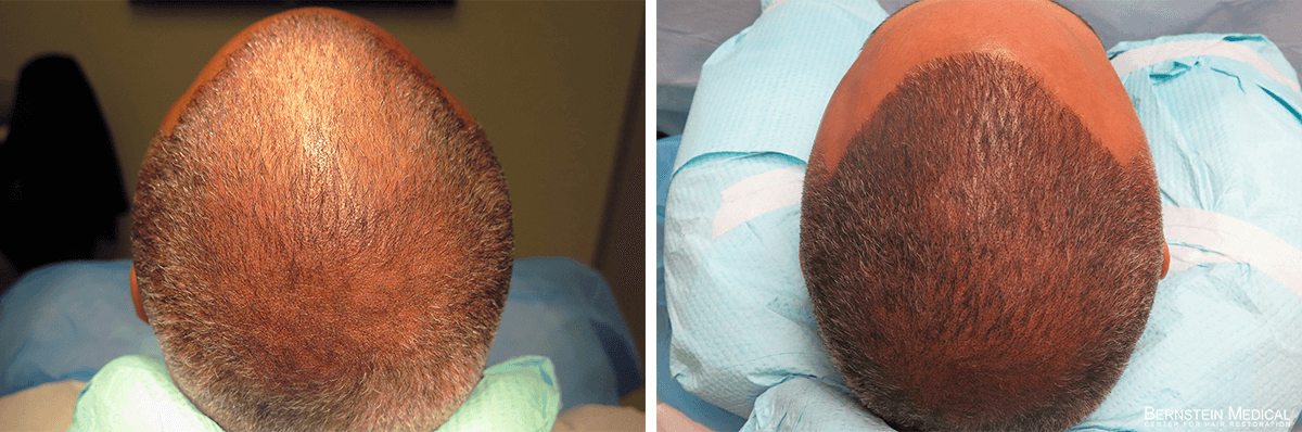 Bernstein Medical - Patient ZLZ Before and After Hair Transplant Photo 