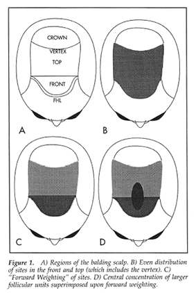 Aesthetics of Follicular Transplantation - Weighting of Hair Transplant Grafts