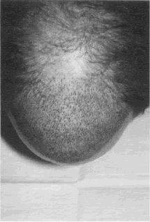 Aesthetics of Follicular Transplantation - Top view showing marked forward weighting of recipient sites