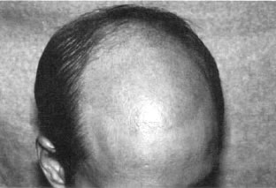 Aesthetics of Follicular Transplantation - Seventeen days post-op