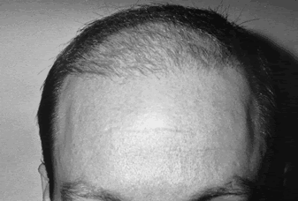 Aesthetics of Follicular Transplantation - Frontal view 4 months post-op