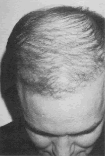 Aesthetics of Follicular Transplantation - Top view at 5 months post-op