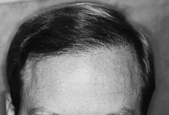 Aesthetics of Follicular Transplantation - Close-up of the frontal hairline at 11 months