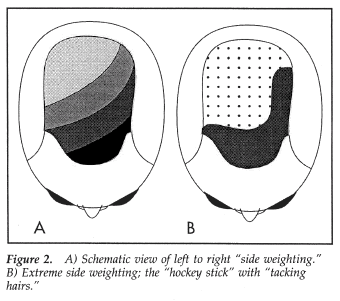 Aesthetics of Follicular Transplantation - Layering of Hair Transplant Grafts