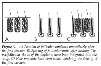 Aesthetics of Follicular Transplantation - Density and Siting of Hair Transplant Grafts