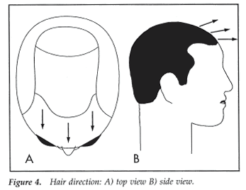 Aesthetics of Follicular Transplantation - Hair Direction