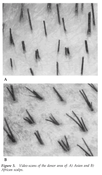 Aesthetics of Follicular Transplantation - Donor Area of Asian (A) and African (B) Scalps