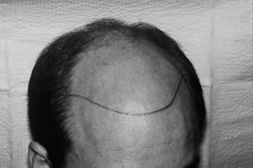 Aesthetics of Follicular Transplantation - Pre-op with hairline drawn 1.5 cm above the upper brow crease at the midline