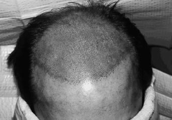 Aesthetics of Follicular Transplantation - Photo taken immediately after the creation of 2,500 recipient sites