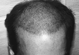 Aesthetics of Follicular Transplantation - Photo taken immediately after the insertion of 2,500 follicular implants