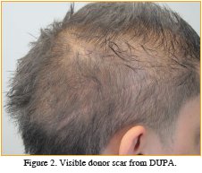 Age and the Donor Zone in FU Hair Transplants - Figure 2