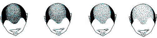 Diffuse Patterned and Unpatterned Alopecia