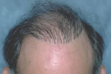 Art of Repair in Surgical Hair Restoration Pt I - The 'dolls head' or 'pluggy look' commonly seen with the punch graft technique