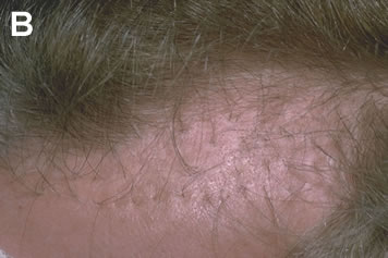 Art of Repair in Surgical Hair Restoration Pt I - 53-year-old male with hair plugs that were transplanted years ago