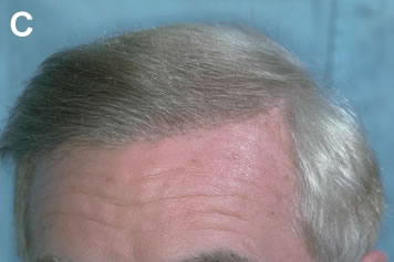 Art of Repair in Surgical Hair Restoration Pt I - Same male patient after one session of follicular units transplanted directly into the scarred tissue