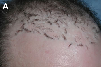 Art of Repair in Surgical Hair Restoration Pt I - Patient with grafts pointing in many different directions