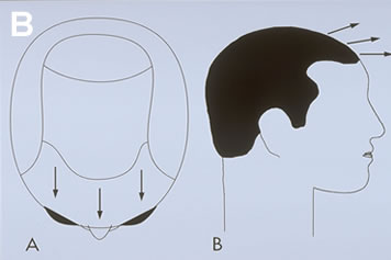 Art of Repair in Surgical Hair Restoration Pt I - Hair should be placed into the scalp at the angle in which it originally grew