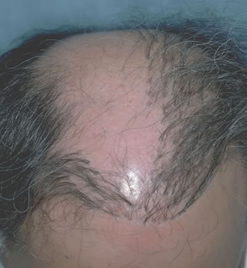 Art of Repair in Surgical Hair Restoration Pt I - Top view of the patient in Figure 1