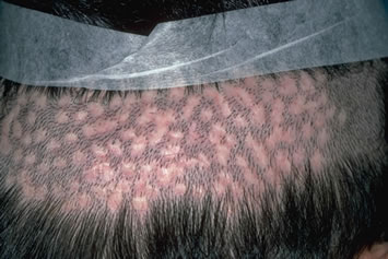 Art of Repair in Surgical Hair Restoration Pt I - Open donor scarring from the punch-graft technique