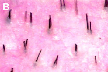 Art of Repair in Surgical Hair Restoration Pt I - Scalp with low density and extensive miniaturization characteristic of androgenetic alopecia
