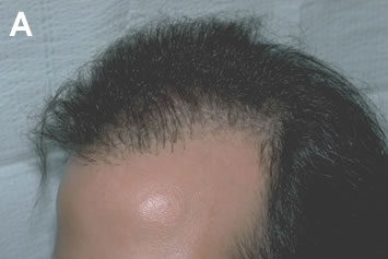 Art of Repair in Surgical Hair Restoration Pt I - Small mini-grafts had been placed too close to the frontal hairline